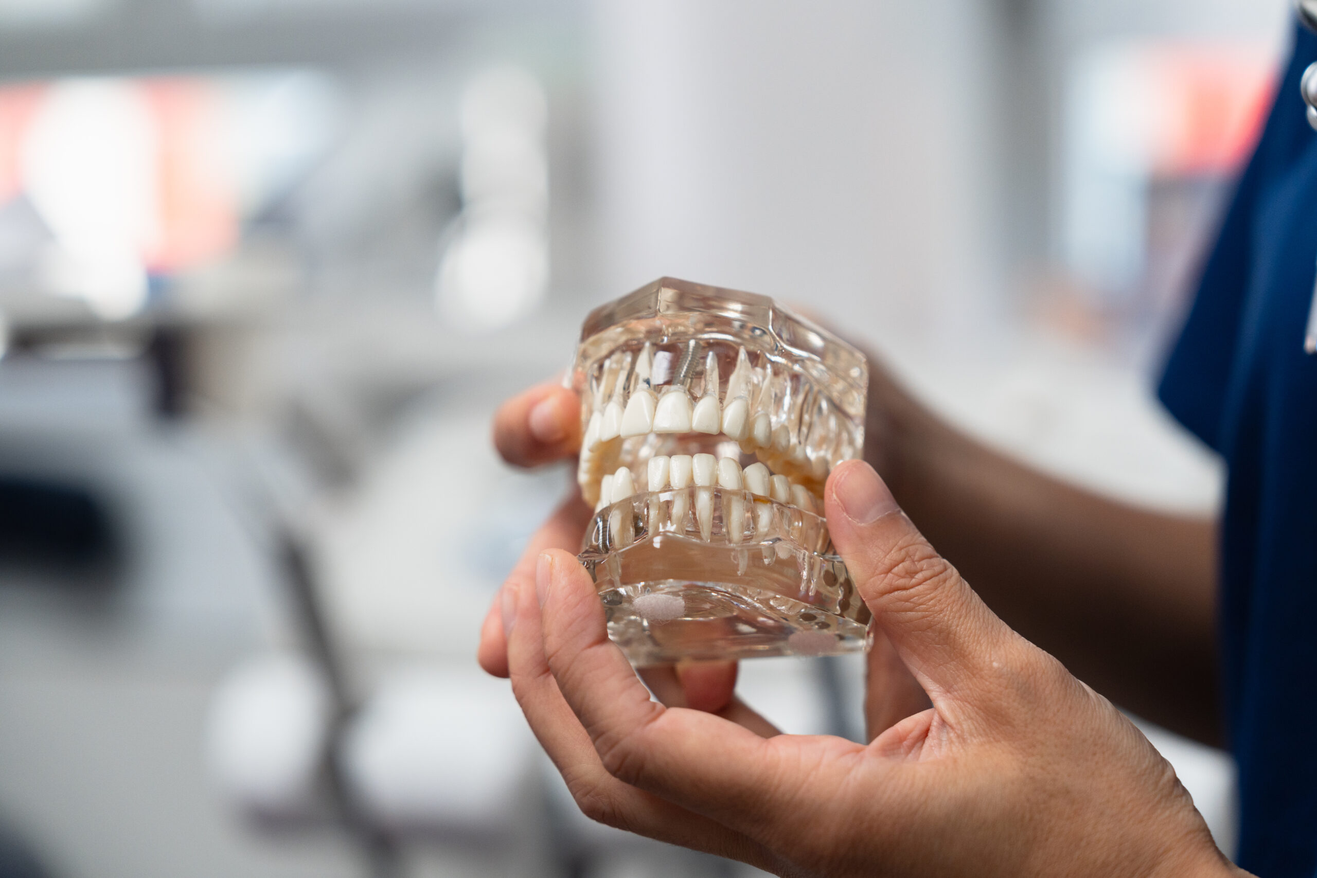 Guide chirurgical implantaire utilisé pour positionner un implant dentaire avec précision